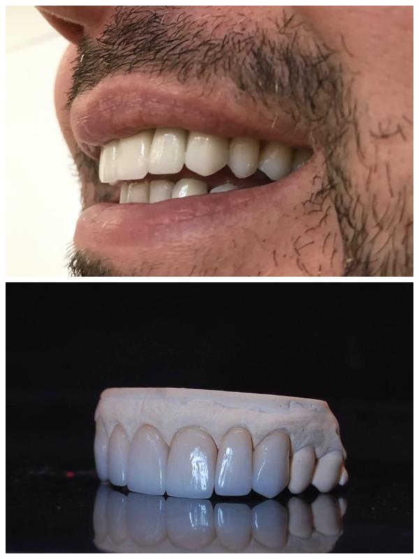 Όψεις press στα έξι πρόσθια δόντια. Ελάχιστη απαιτούμενη παρασκευή δοντιών με τελικό πάχος αποκατάστασης 0,7mm